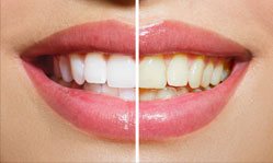 woman before and after smile for smile gallery