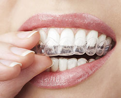 Woman places retainer on upper teeth
